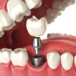 Implant nha khoa – Giải pháp tối ưu cho răng miệng của bạn