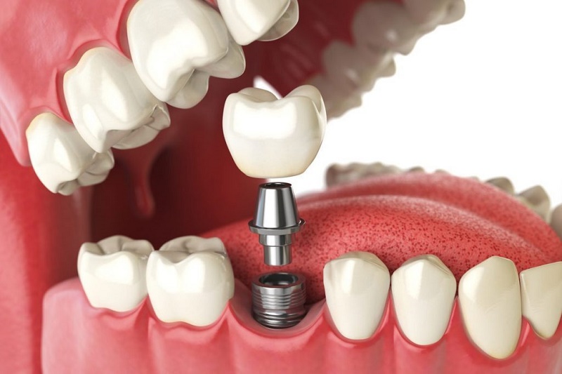 Implant nha khoa – Giải pháp tối ưu cho răng miệng của bạn