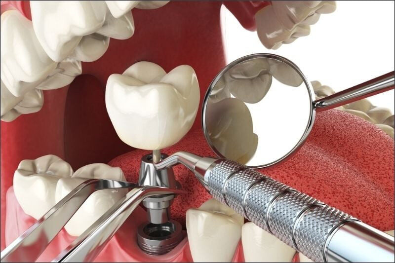 Mô hình trồng răng Implant