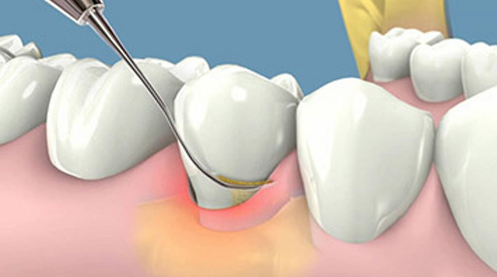 Hình ảnh minh họa quy trình lấy cao răng chuyên nghiệp