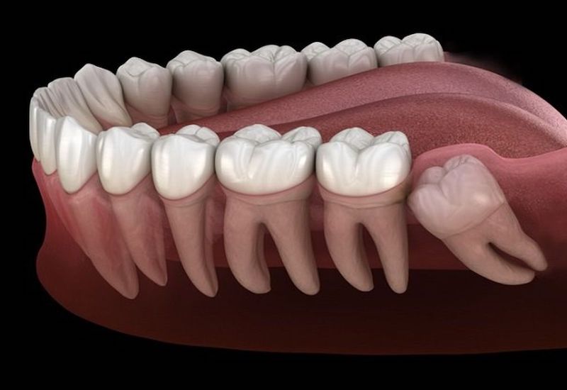 Sưng chân răng cấm: Nguyên nhân và cách điều trị ra sao?