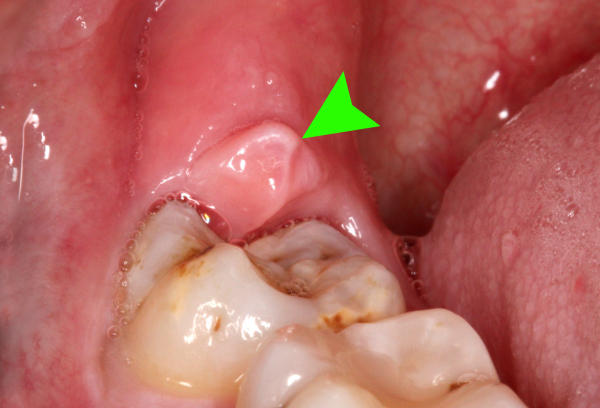 Sưng nướu: Nguyên nhân và cách xử lý đơn giản