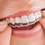 Tìm hiểu A-Z về niềng răng trong suốt Invisalign – 2024